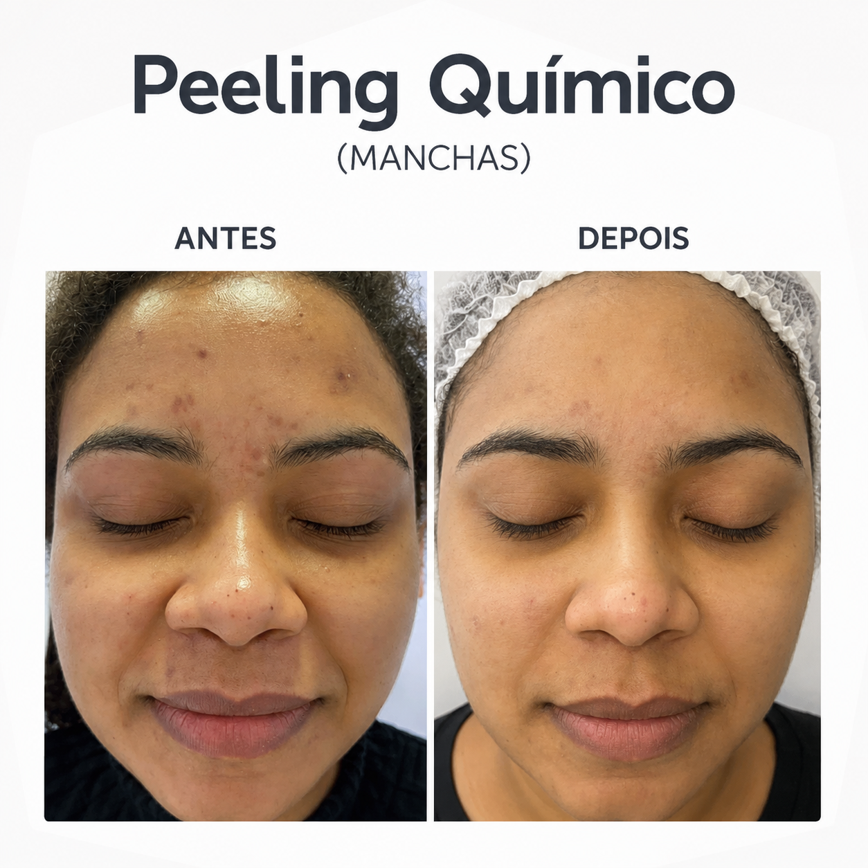 Antes e depois de algumas sessões de pelling, resultado natural